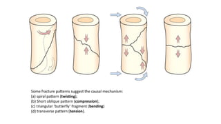 Some fracture patterns suggest the causal mechanism:
(a) spiral pattern (twisting);
(b) Short oblique pattern (compression);
(c) triangular ‘butterfly’ fragment (bending)
(d) transverse pattern (tension).
 