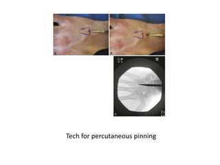 Fractures and dislocations of hand | PPTX