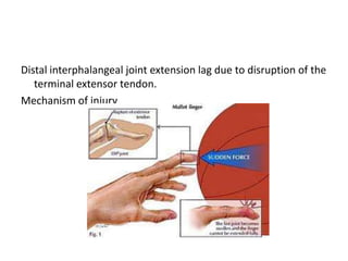 Fractures and dislocations of hand | PPTX