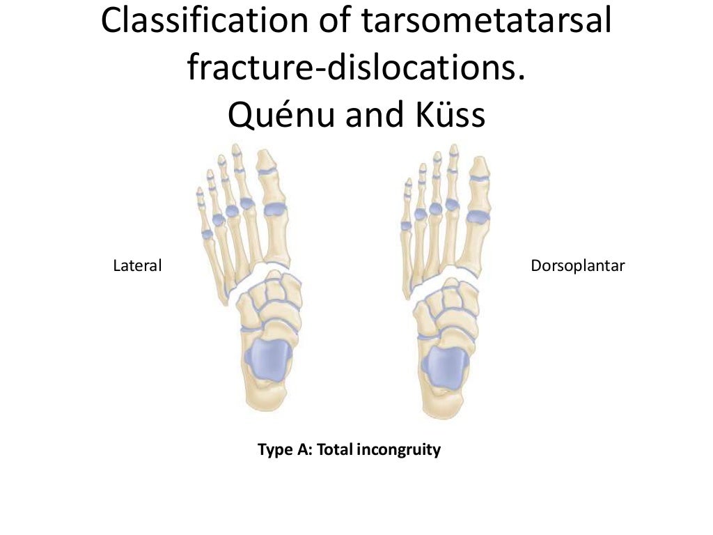 Fractures and fracture dislocations of the tarsometatarsal joint