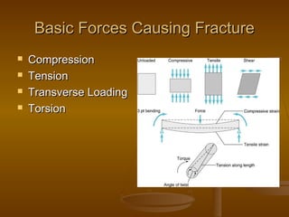 Basic Forces Causing FractureBasic Forces Causing Fracture
 CompressionCompression
 TensionTension
 Transverse LoadingTransverse Loading
 TorsionTorsion
 