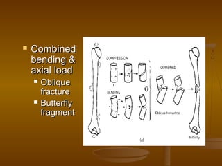  CombinedCombined
bending &bending &
axial loadaxial load
 ObliqueOblique
fracturefracture
 ButterflyButterfly
fragmentfragment
 