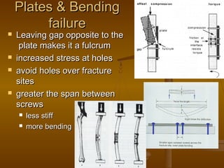 Plates & BendingPlates & Bending
failurefailure
 Leaving gap opposite to theLeaving gap opposite to the
plate makes it a fulcrumplate makes it a fulcrum
 increased stress at holesincreased stress at holes
 avoid holes over fractureavoid holes over fracture
sitessites
 greater the span betweengreater the span between
screwsscrews
 less stiffless stiff
 more bendingmore bending
 