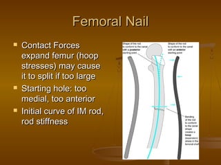 Femoral NailFemoral Nail
 Contact ForcesContact Forces
expand femur (hoopexpand femur (hoop
stresses) may causestresses) may cause
it to split if too largeit to split if too large
 Starting hole: tooStarting hole: too
medial, too anteriormedial, too anterior
 Initial curve of IM rod,Initial curve of IM rod,
rod stiffnessrod stiffness
 