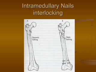 Intramedullary NailsIntramedullary Nails
interlockinginterlocking
 