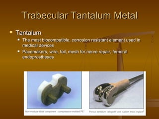 Trabecular Tantalum MetalTrabecular Tantalum Metal
 TantalumTantalum
 The most biocompatible, corrosion resistant element used inThe most biocompatible, corrosion resistant element used in
medical devicesmedical devices
 Pacemakers, wire, foil, mesh for nerve repair, femoralPacemakers, wire, foil, mesh for nerve repair, femoral
endoprosthesesendoprostheses
 