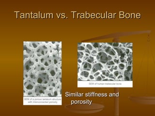Tantalum vs. Trabecular BoneTantalum vs. Trabecular Bone
Similar stiffness andSimilar stiffness and
porosityporosity
 