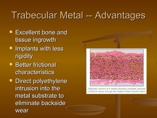 Trabecular Metal -- AdvantagesTrabecular Metal -- Advantages
 Excellent bone andExcellent bone and
tissue ingrowthtissue ingrowth
 Implants with lessImplants with less
rigidityrigidity
 Better frictionalBetter frictional
characteristicscharacteristics
 Direct polyethyleneDirect polyethylene
intrusion into theintrusion into the
metal substrate tometal substrate to
eliminate backsideeliminate backside
wearwear
 