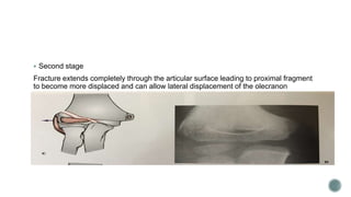  Second stage
Fracture extends completely through the articular surface leading to proximal fragment
to become more displaced and can allow lateral displacement of the olecranon
 