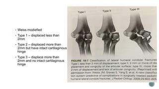  Weiss modiefied
 Type 1 – displaced less than
2mm
 Type 2 – displaced more than
2mm but have intact cartilaginous
hinge
 Type 3 – displace more than
2mm and no intact cartilaginous
hinge
 