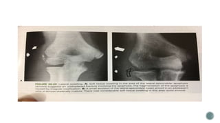 Fractures around elbow joint in children