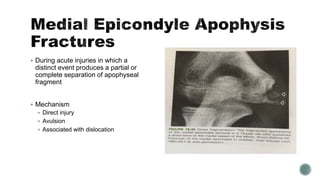  During acute injuries in which a
distinct event produces a partial or
complete separation of apophyseal
fragment
 Mechanism
 Direct injury
 Avulsion
 Associated with dislocation
 