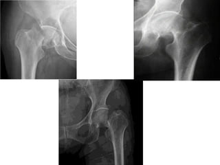 Fractures Around Hip Pptx