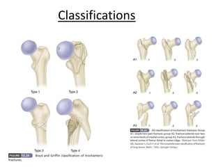 Fractures around hip | PPTX