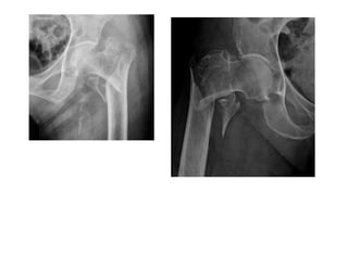 Fractures Around Hip Pptx