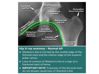 Fractures Around Hip Pptx