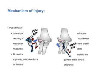 Raidal Condyle Fractures_Around_Paediatric_Elbow.pptx.. | PPTX