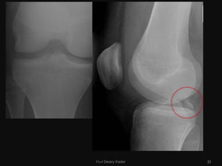 Fractures around the knee for connect Physio Newcastle