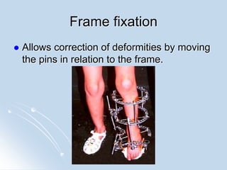 Descursion Frame Fixed Fractures, bone healing & principles of tx. of fractures | PPT