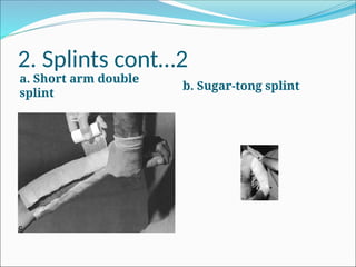 Two Splints FRACTURES, definition, classification, management 4.2 BMS.pptx
