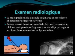Examen radiologique
 La radiographie de la clavicule se fait avec une incidence
oblique pour dégager la clavicule.
 Permet de voir la nature du trait de fracture (transversale,
oblique, avec plusieurs fragments) et son siège par rapport
aux insertions musculaires et ligamentaires .
 