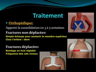 Traitement
 Orthopédique:
Apporte la consolidation en 3 à 5 semaines.
Fractures non déplacées:
Simple écharpe pour soutenir le membre supérieur
Chez l’enfant : idem
Fractures déplacées:
Bandage en huit réglable
Fréquence des cals vicieux
 