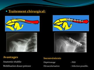  Traitement chirurgical:
 Retard de consolidation
 Infection possible
Avantages
Anatomie rétablie
Mobilisation douce précoce
Inconvénients
Dépériostage - PSD
Dévascularisation - Infection possible.
 
