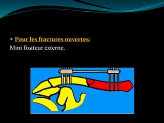  Pour les fractures ouvertes:
Mini fixateur externe.
 