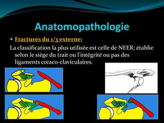 Anatomopathologie
 Fractures du 1/3 externe:
La classification la plus utilisée est celle de NEER; établie
selon le siège du trait ou l’intégrité ou pas des
ligaments coraco-claviculaires.
 
