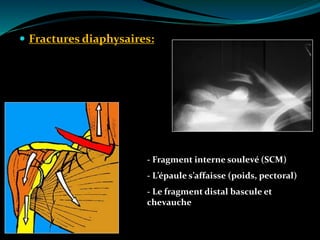  Fractures diaphysaires:
- Fragment interne soulevé (SCM)
- L’épaule s’affaisse (poids, pectoral)
- Le fragment distal bascule et
chevauche
 