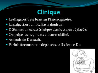 Clinique
 Le diagnostic est basé sur l’interrogatoire.
 La palpation qui localise la douleur.
 Déformation caractéristique des fractures déplacées.
 On palpe les fragments et leur mobilité.
 Attitude de Dessault.
 Parfois fractures non déplacées, la Rx fera le Dc.
 