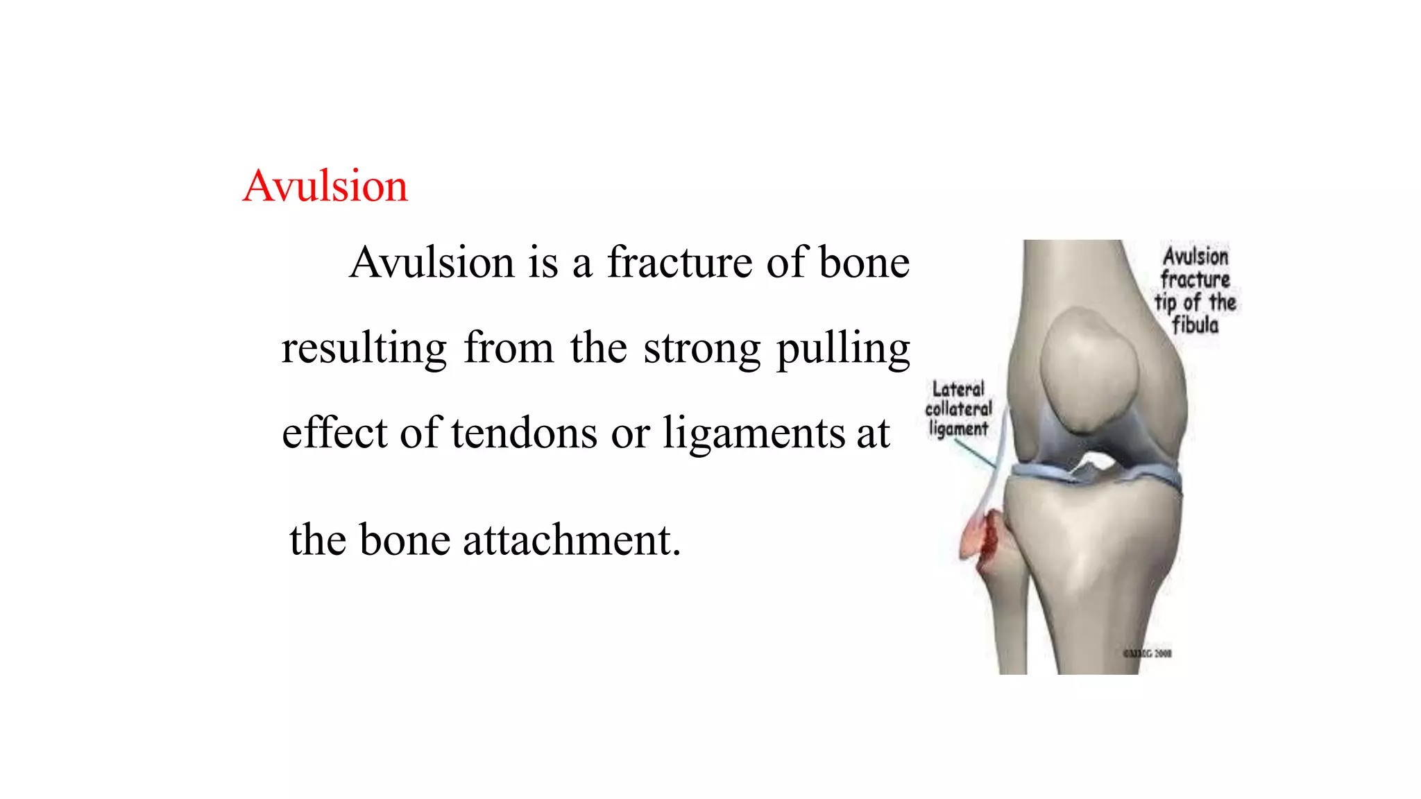 Fracture classification | PPTX