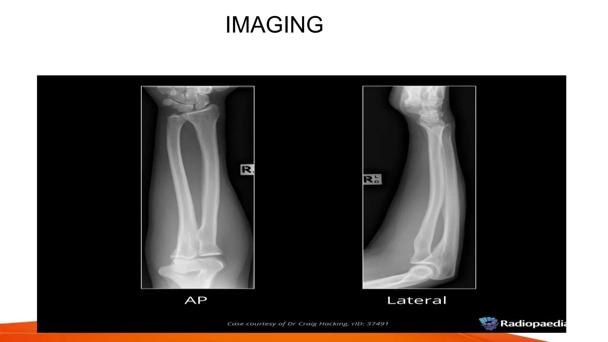 Fracture shaft of radius ulna 2021 | PPTX