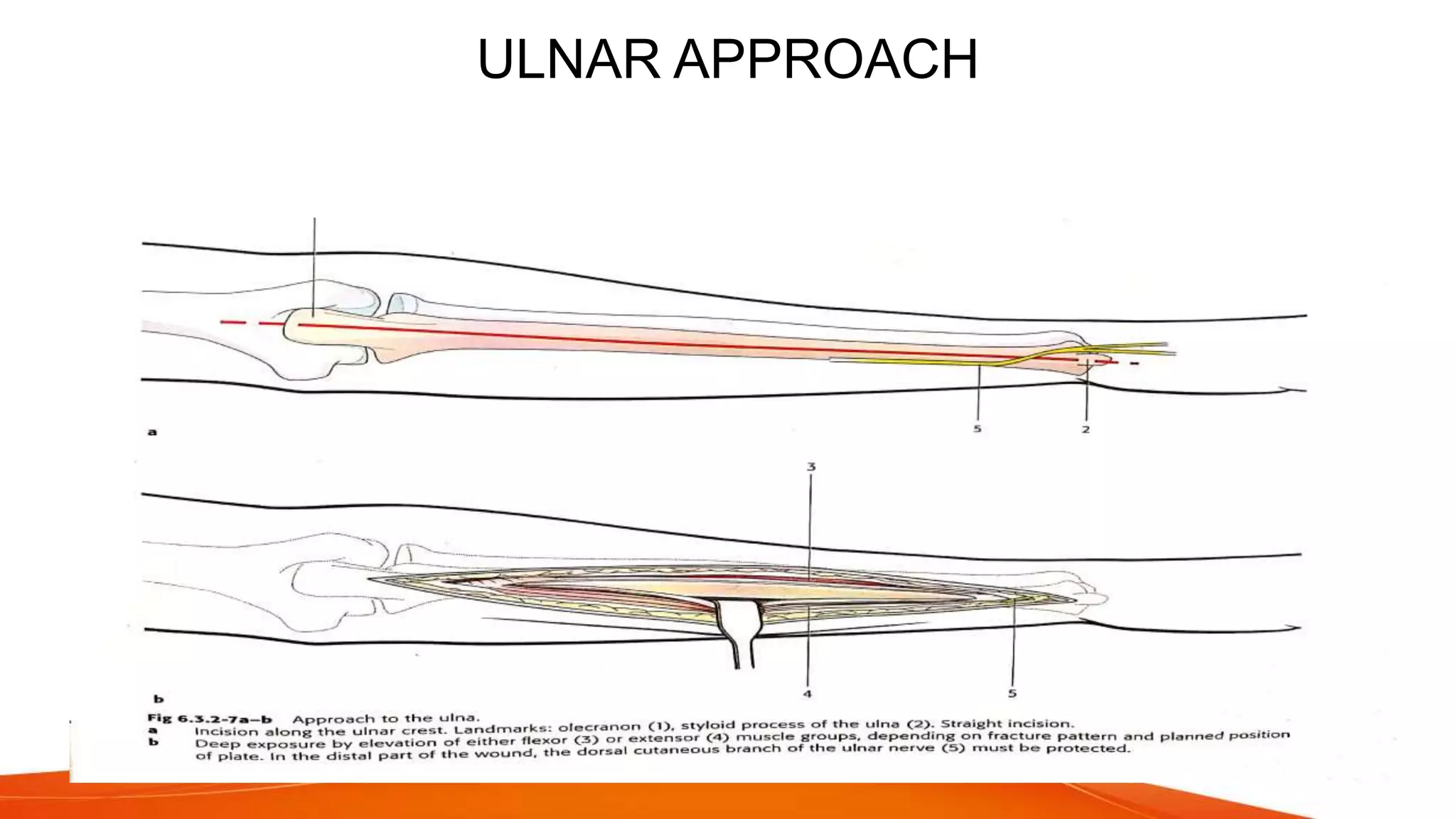 Fracture shaft of radius ulna 2021 | PPTX