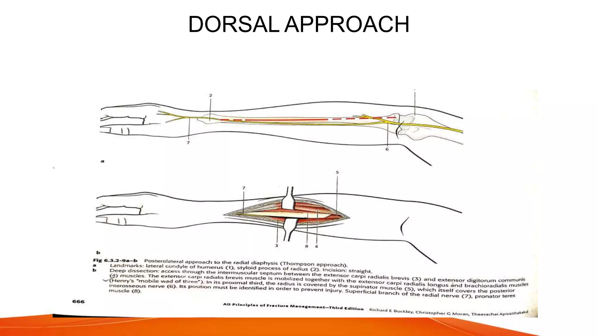 Fracture shaft of radius ulna 2021 | PPTX