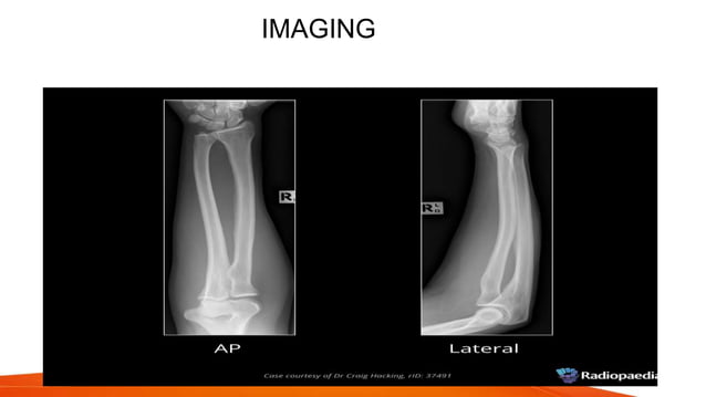 Fracture shaft of radius ulna 2021 | PPTX