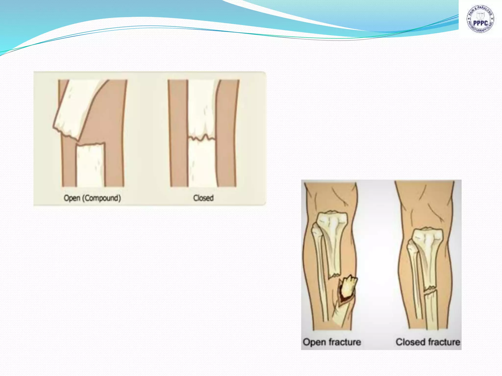 Fractures healing complication & management | PPTX