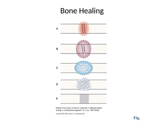 Bone Healing
Fig.
 