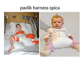 pavlik harness spica
 