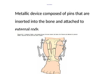 External fixation
Metallic device composed of pins that are
inserted into the bone and attached to
external rods
 