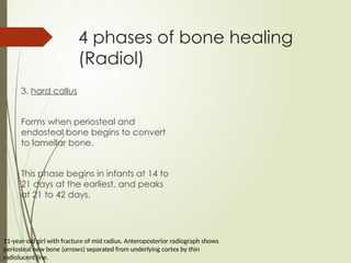 Initial Callus Formation Fractures in Children Mechanisms and Estimations.pptx