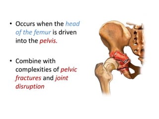 • Occurs when the head
of the femur is driven
into the pelvis.
• Combine with
complexities of pelvic
fractures and joint
disruption
 