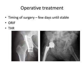 Operative treatment
• Timing of surgery – few days until stable
• ORIF
• THR
 
