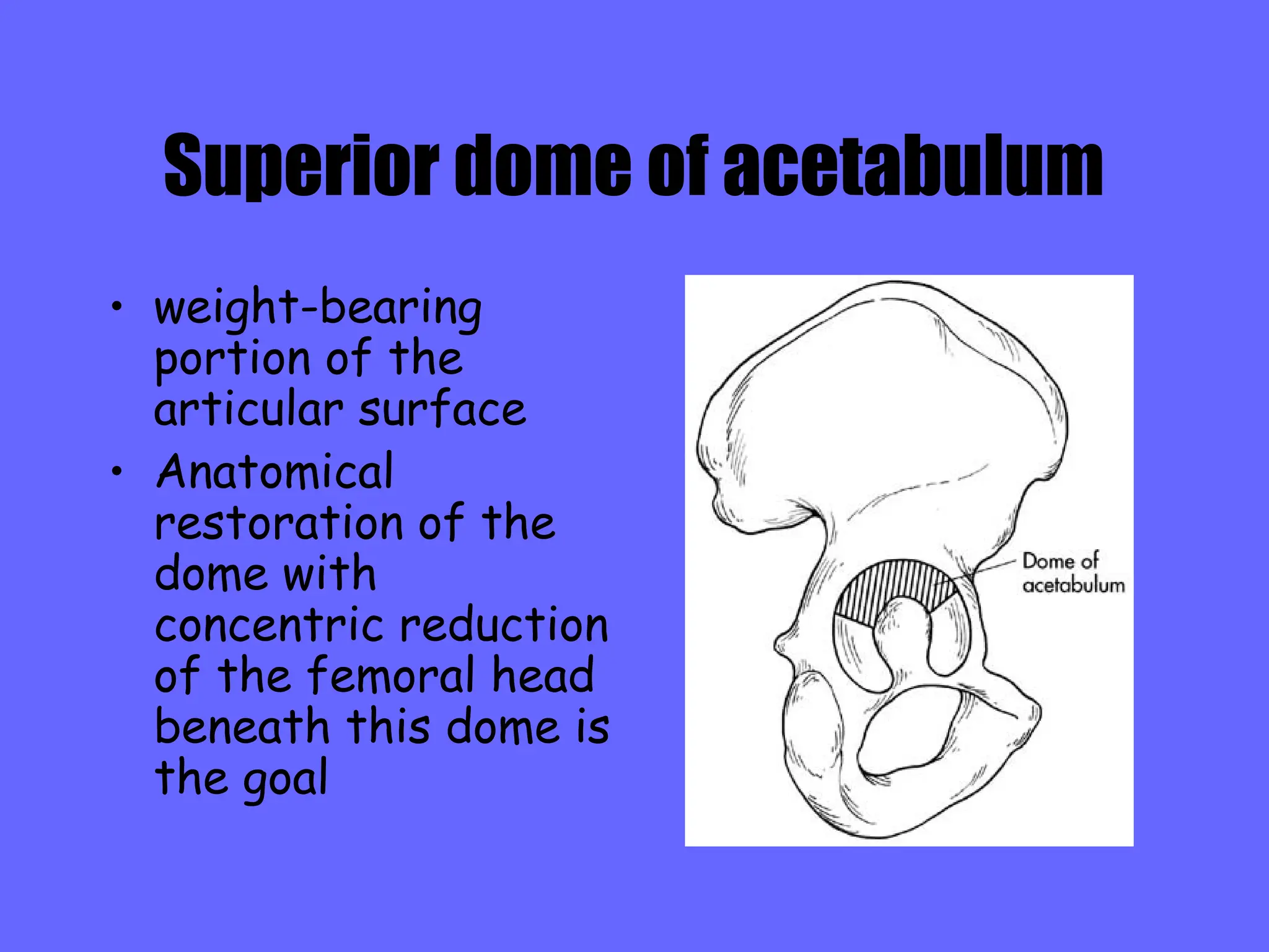Fractures Of Acetabulum Ppt Fractures Around Hip Ppt