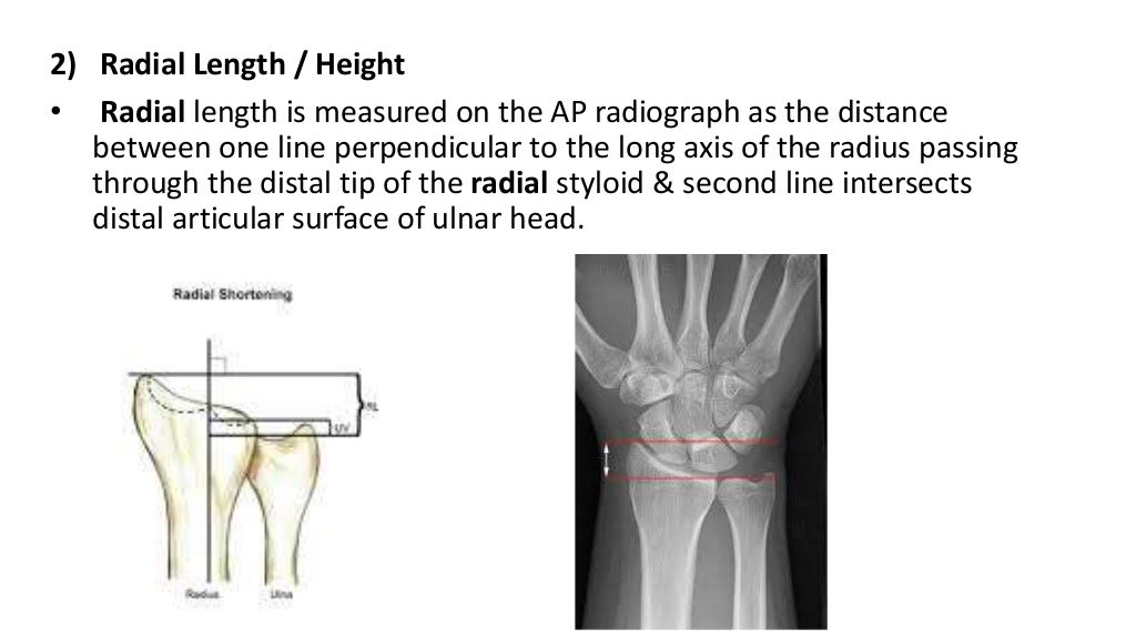 Fractures of distal end radius