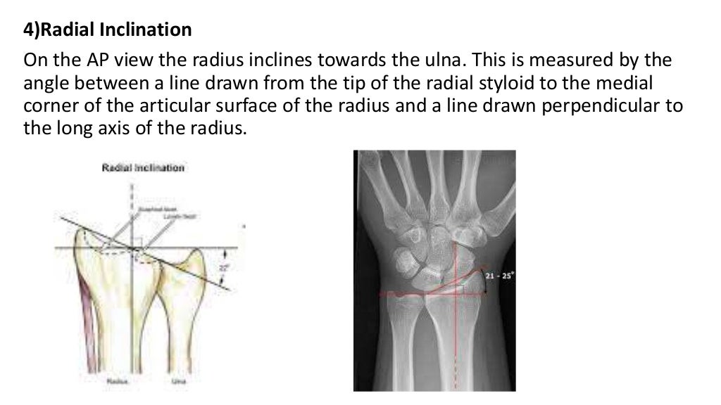 Fractures of distal end radius