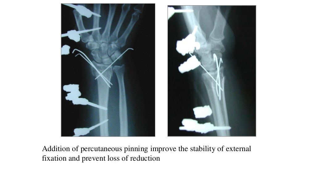 Fractures of distal end radius