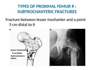 FRACTURES OF PROXIMAL FEMUR ORTHOPEDICS.pptx