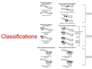 Fractures of the clavicle | PPT