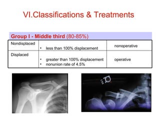 VI.Classifications & Treatments   Group I - Middle third  (80-85%) Nondisplaced <ul><li>less than 100% displacement  </li>...